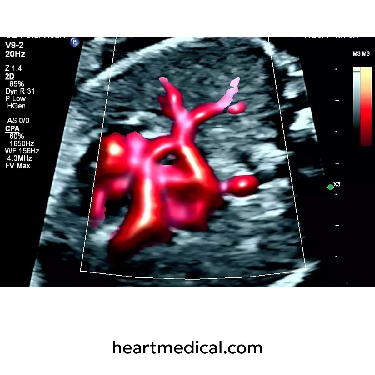 Ultrasound image of a blood vessel with red coloration, displayed on a screen with technical data.