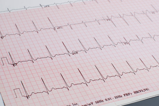 Borderline ECG, what is Borderline ECG