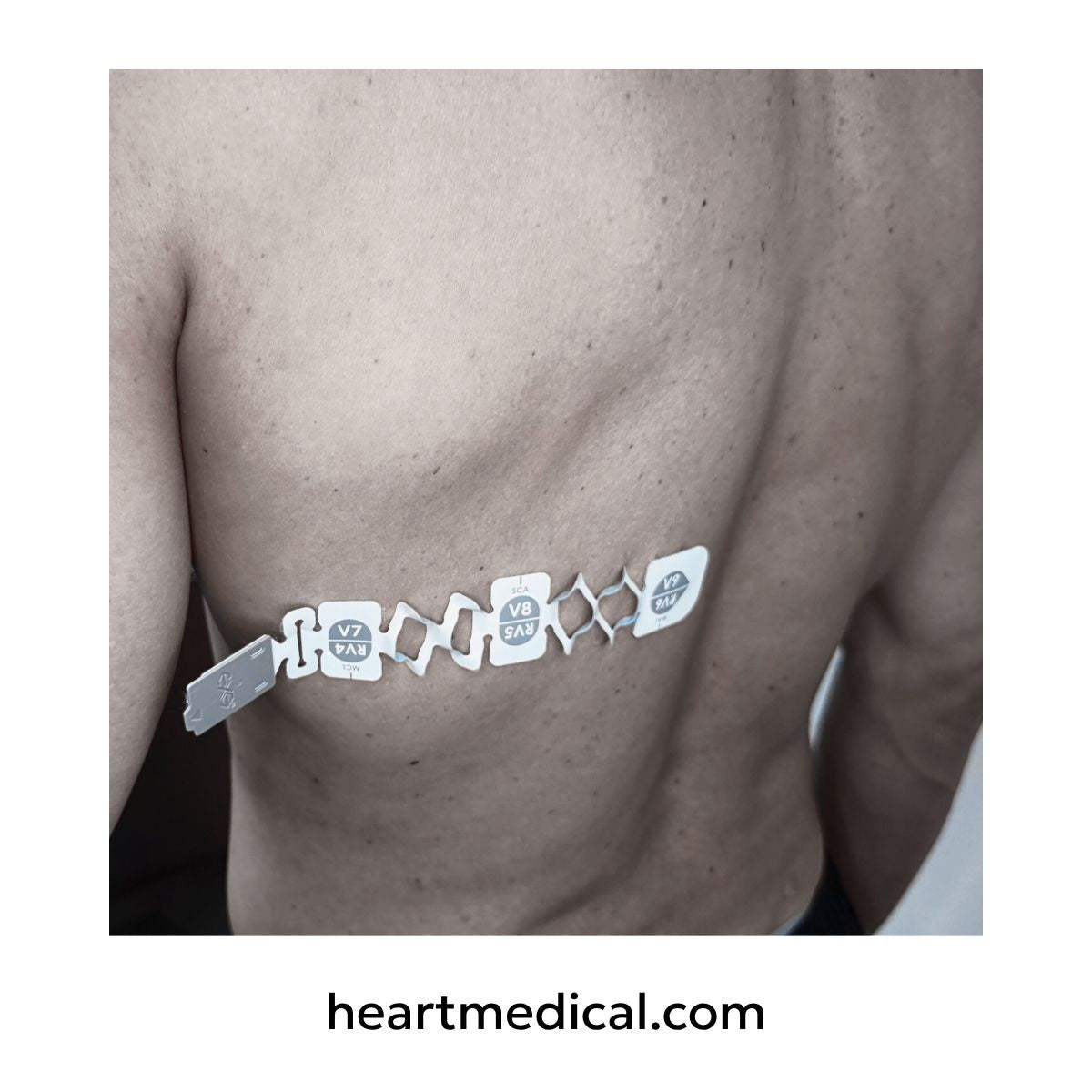 Back view of EXG 3-Lead Wearable ECG applied in posterior orientation