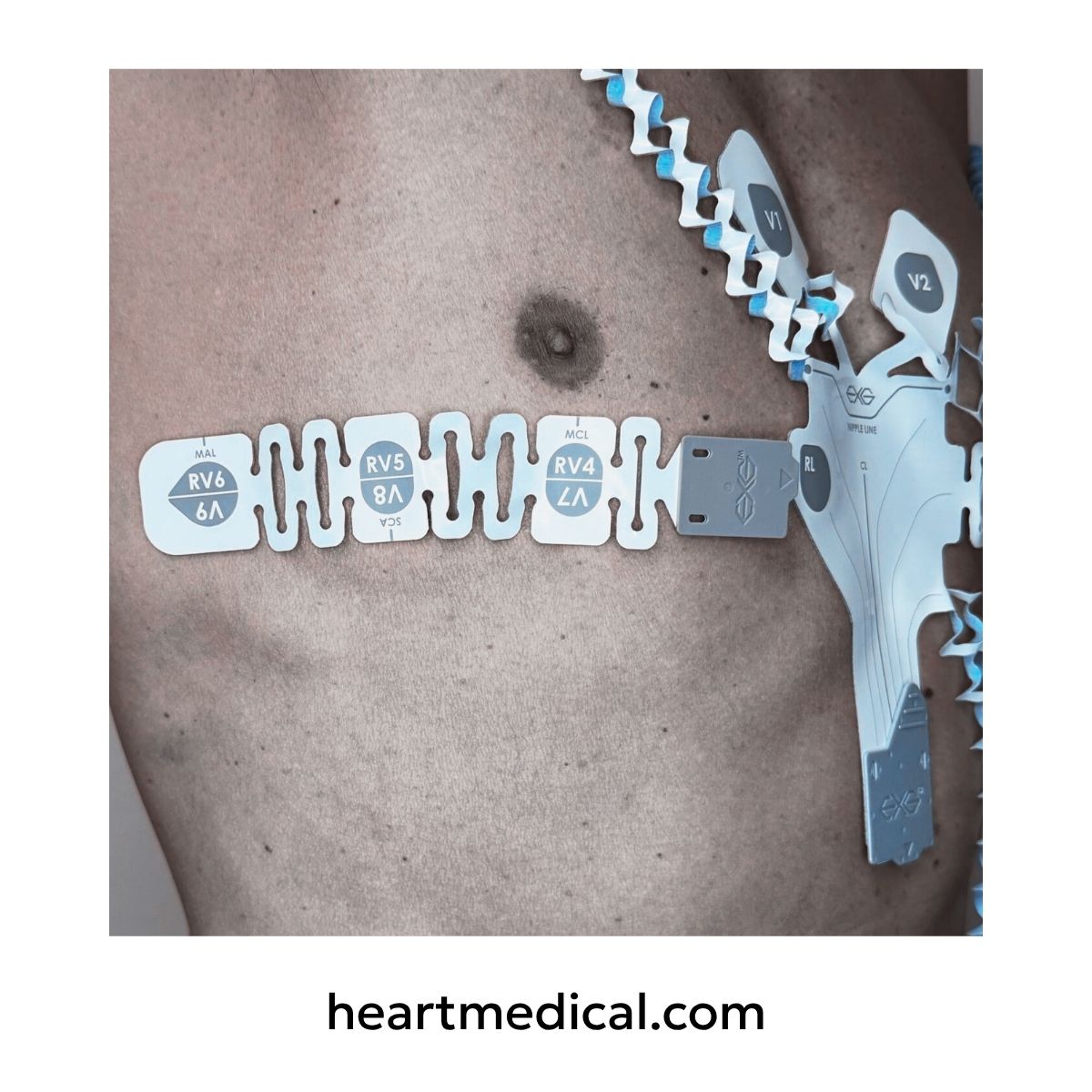 EXG 12-Lead and 3-Lead Wearable ECG combined for 18-Lead diagnostic view