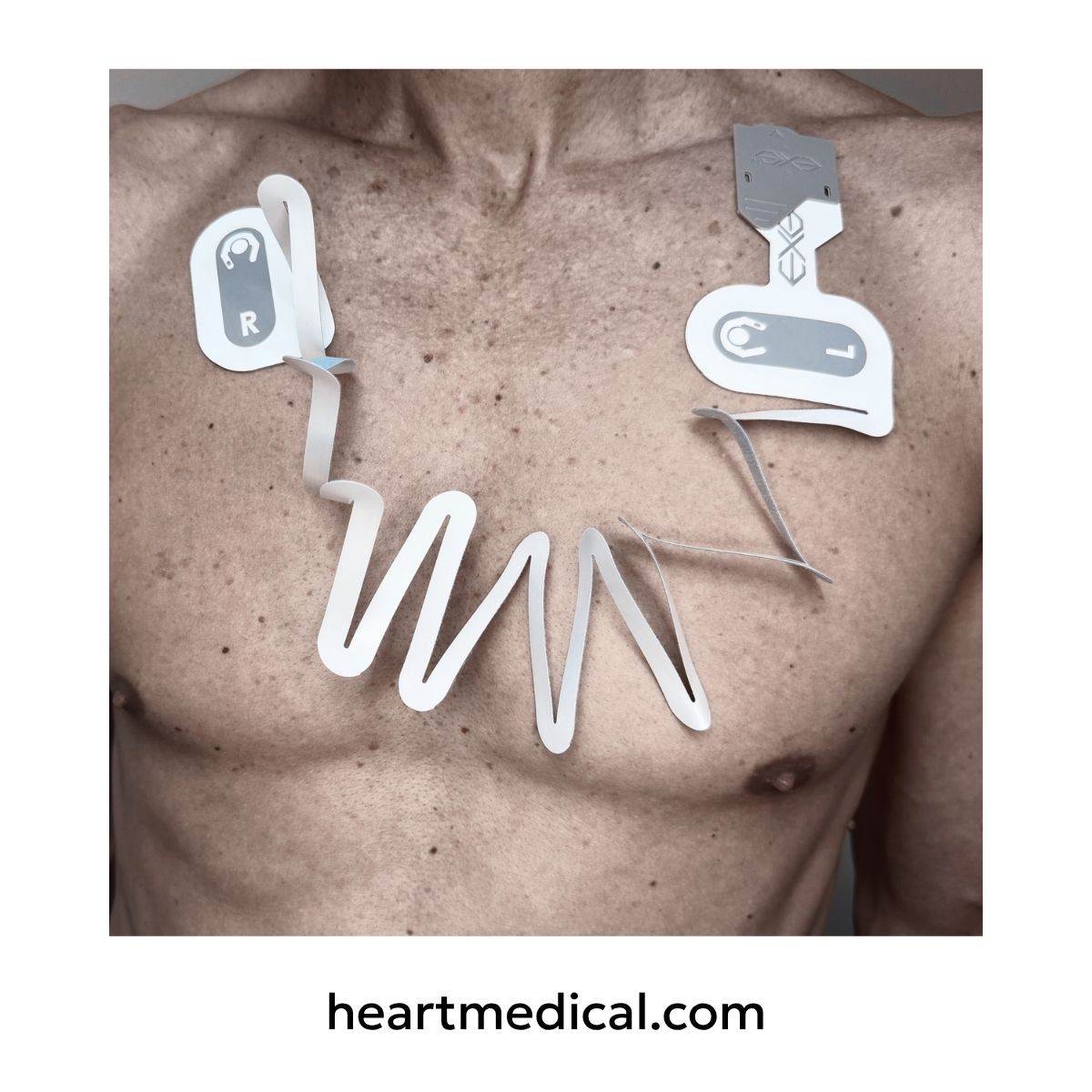 EXG 4-Electrode Wearable ECG in limb-to-torso EMS placement