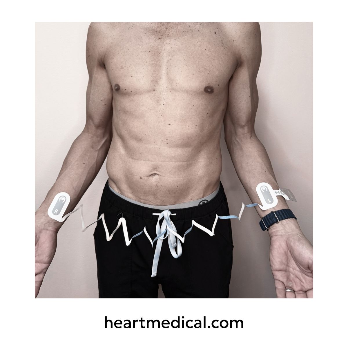 EXG 4-Electrode Wearable ECG in wrist-to-wrist EMS placement
