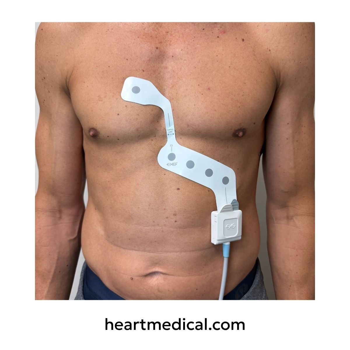 EXG 5-Lead Wearable ECG on patient torso with single-cable adapter attached