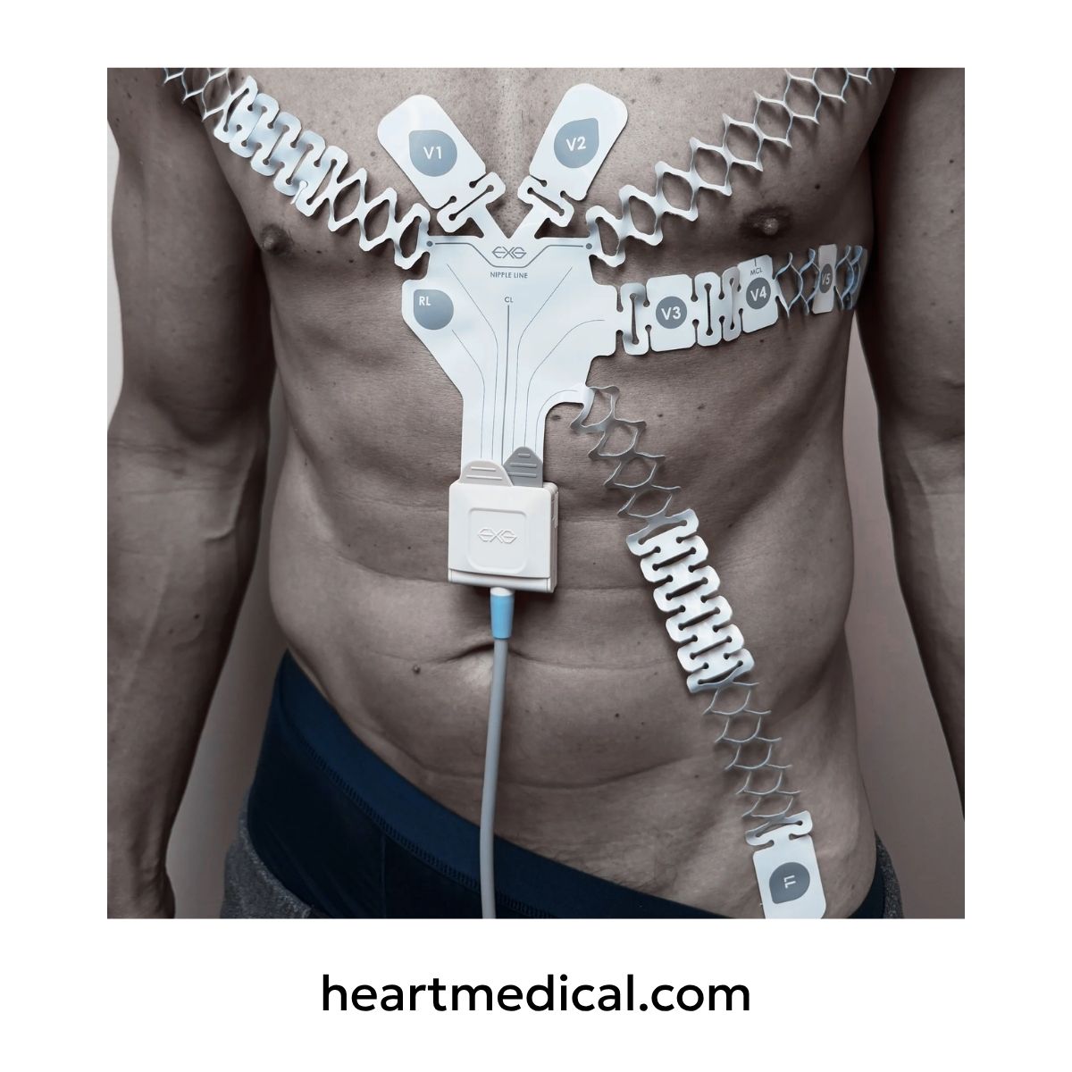 EXG 12-Lead Wearable ECG applied to torso with limb extensions and adapter connected