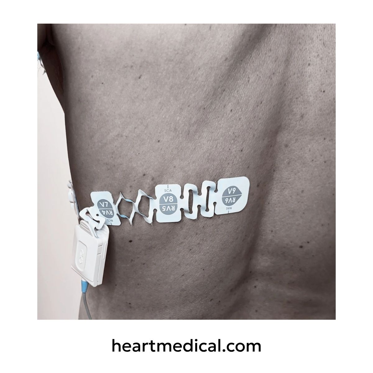 EXG 3-Lead Wearable ECG close-up in posterior orientation with V7, V8, V9 electrodes