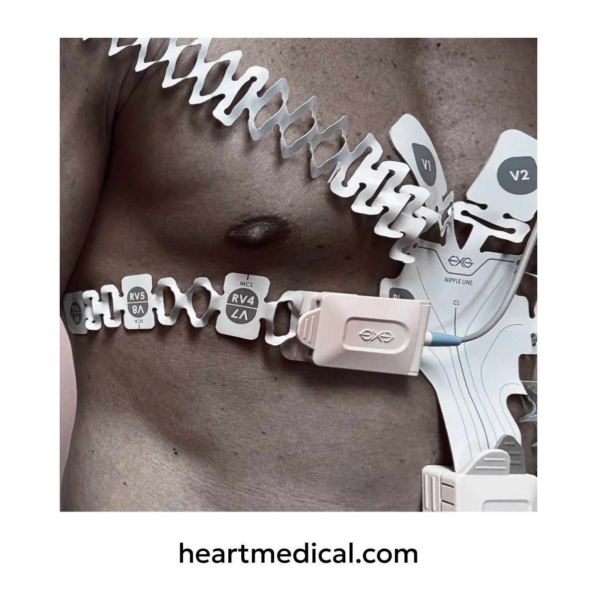 EXG 12-Lead with 3-Lead extension applied to chest for 18-Lead diagnostic view