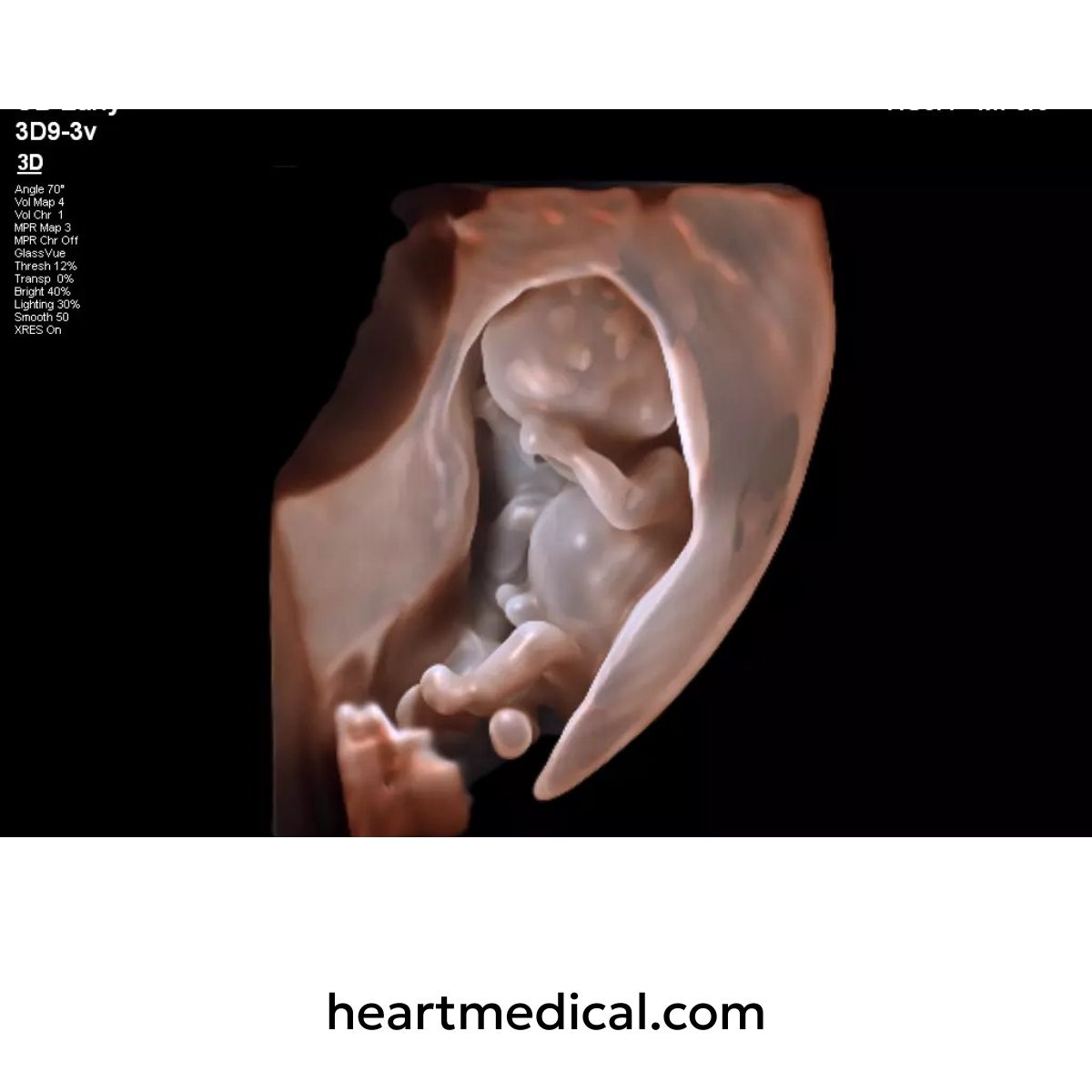 3D fetal ultrasound image captured using Philips EPIQ Elite ultrasound system
