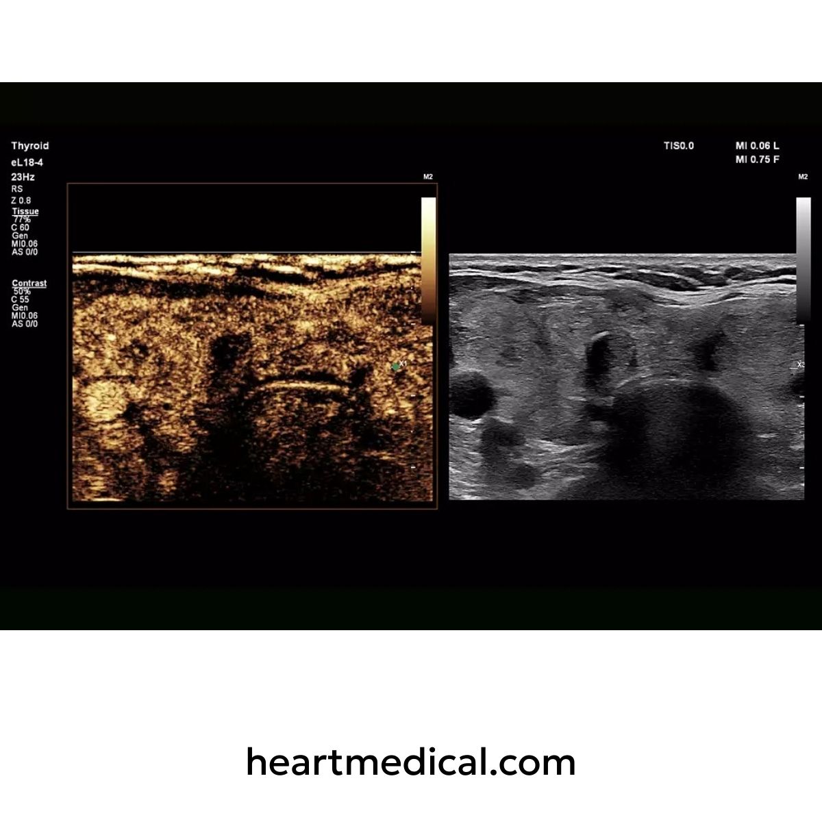Ultrasound images of a thyroid gland with 'heartmedical.com' branding.