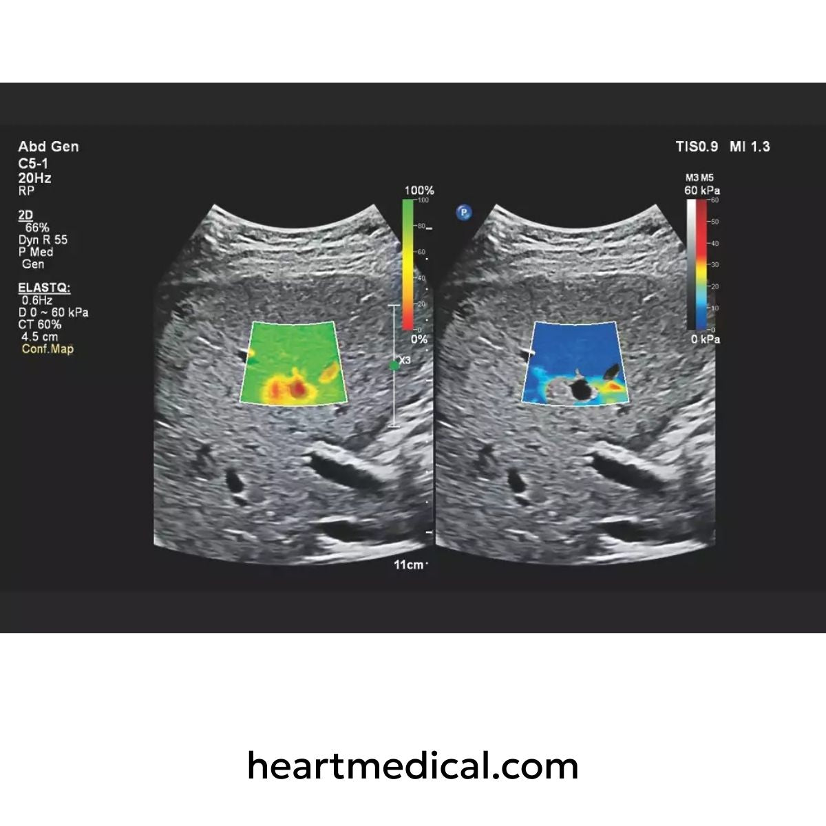 Ultrasound scan of a human abdomen with color Doppler mapping on a black background.