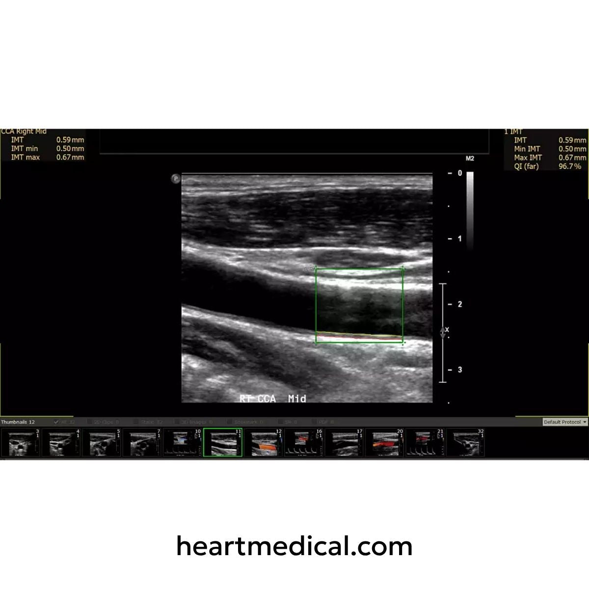 Carotid artery ultrasound image with intima-media thickness measurements displayed in Philips Ultrasound Workspace