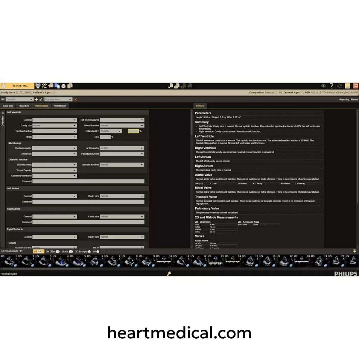 Philips Ultrasound Workspace reporting interface showing cardiac measurements, structured reporting, and analysis tools