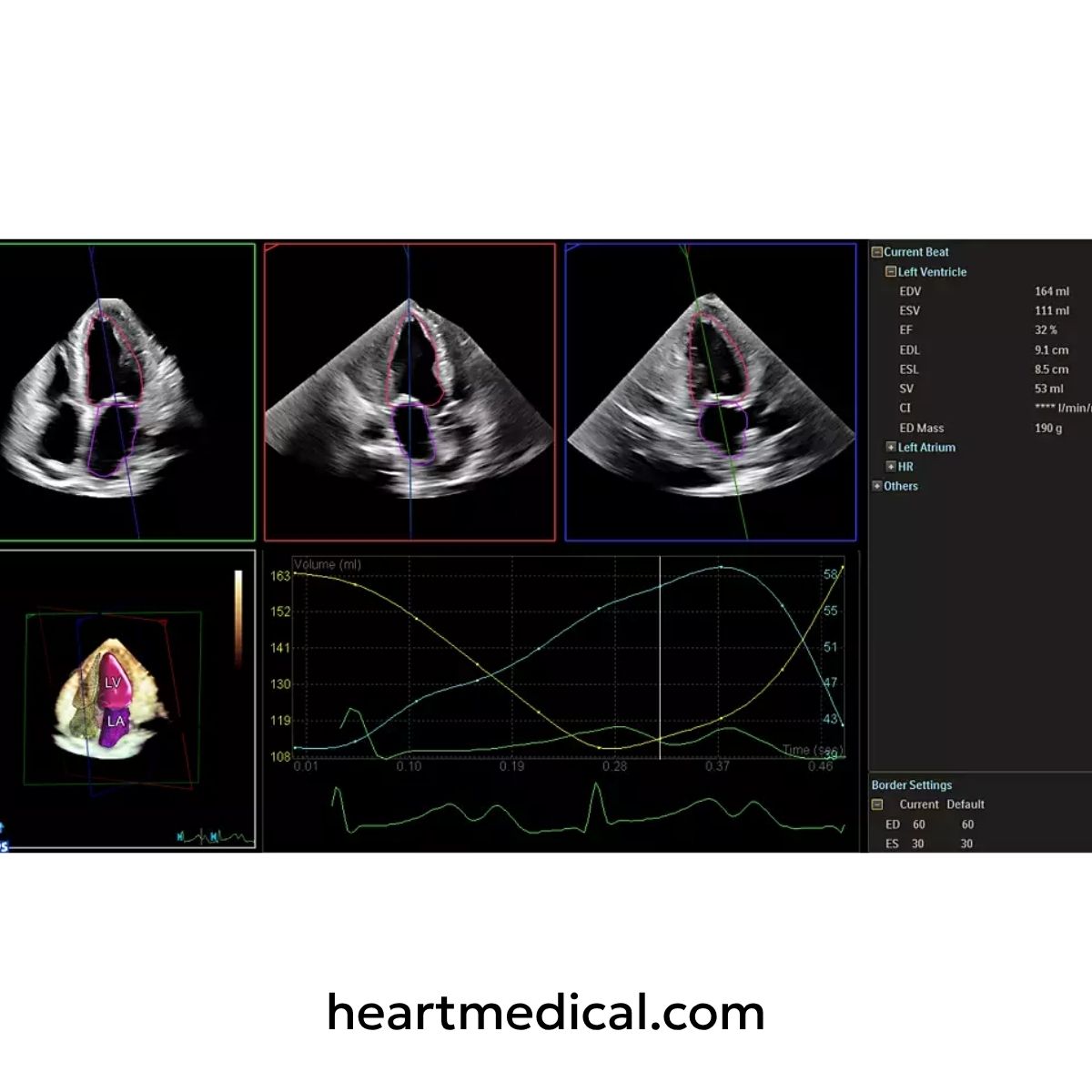 Medical ultrasound scan display with various views and graphs on a screen, powered by Philips Ultrasound Worspace
