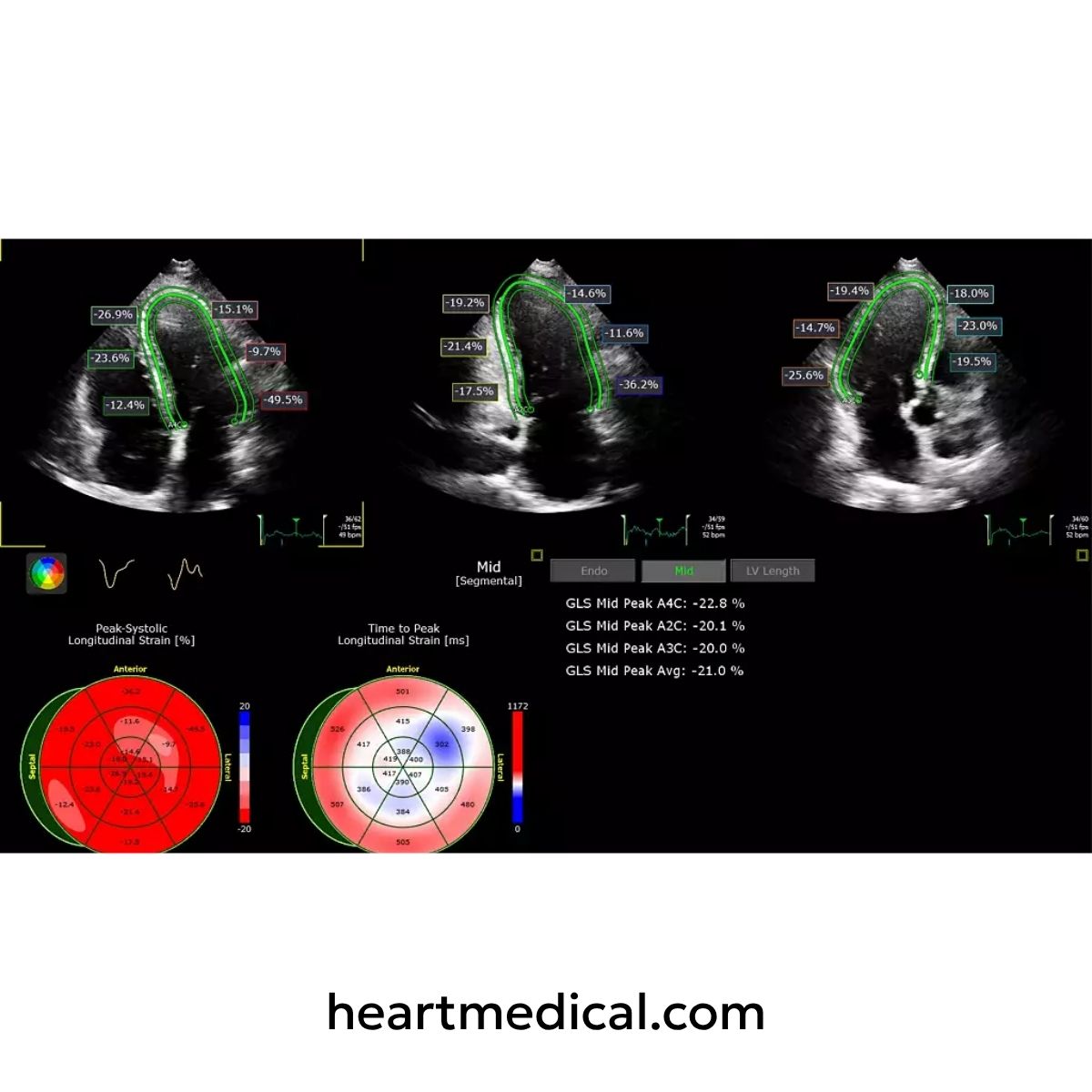 Medical ultrasound scan of a heart with analysis tools on a black background, using the Philips Ultrasound Worspace.