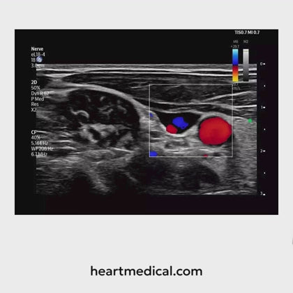 Philips Flash 5100 POC Point-of-Care Ultrasound System — Product Screen Overview