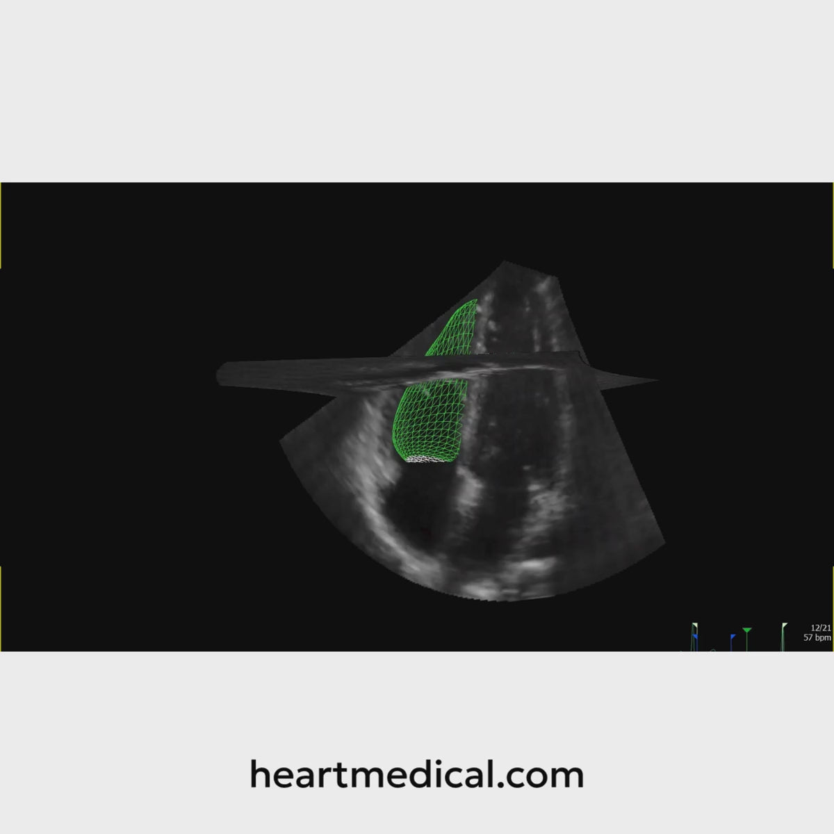 Philips Ultrasound Worspace video demo