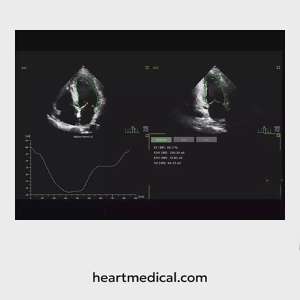 Philips Affiniti CVx everyday cardiovascular ultrasound system on mobile cart with adjustable monitor and control panel